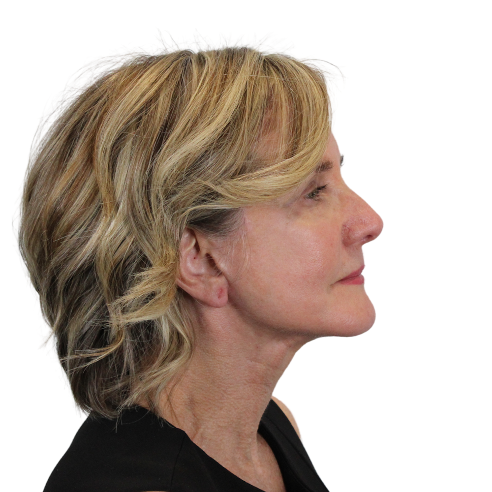 Deep Neck Lift Before & After Gallery - Patient 375943 - Image 6