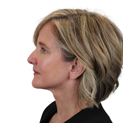 Deep Neck Lift Before & After Gallery - Patient 375943 - Image 12