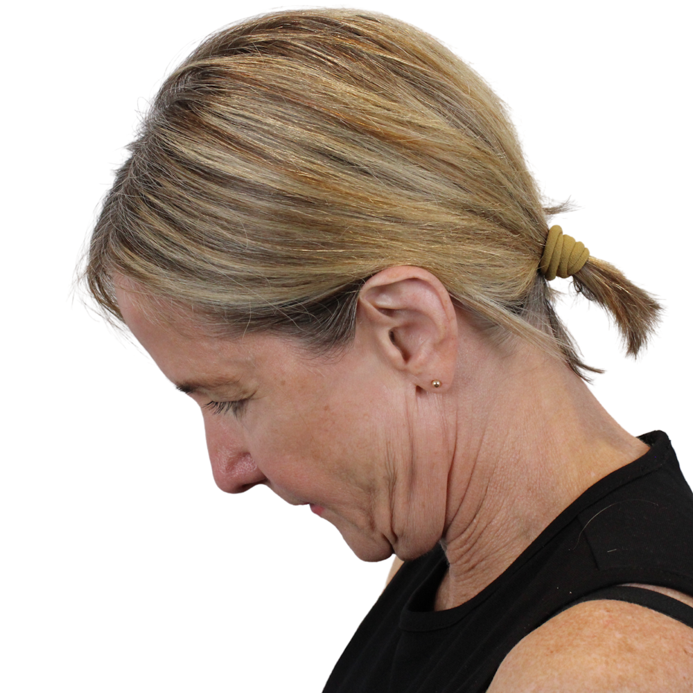Deep Neck Lift Before & After Gallery - Patient 375943 - Image 13