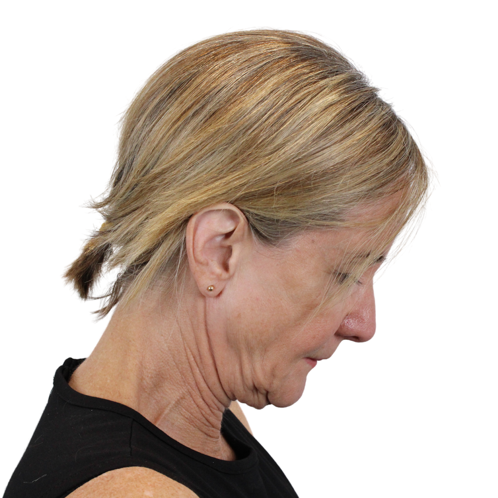 Deep Neck Lift Before & After Gallery - Patient 375943 - Image 7