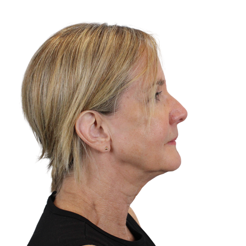Deep Plane Facelift Before & After Gallery - Patient 980290 - Image 5