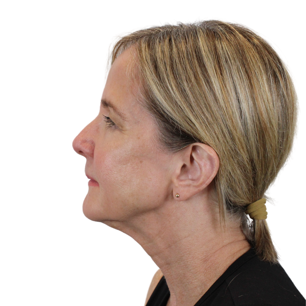 Deep Plane Facelift Before & After Gallery - Patient 980290 - Image 11