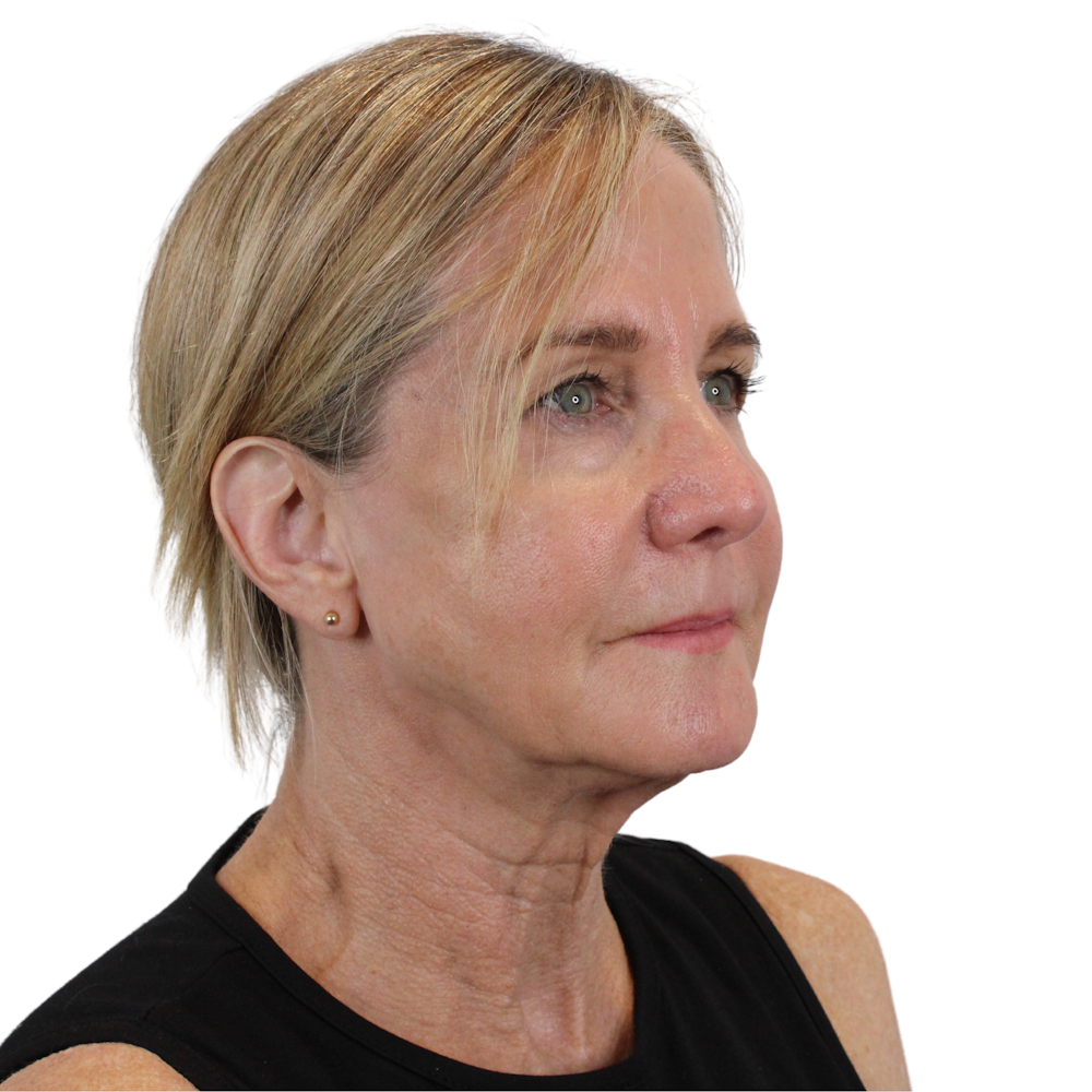 Deep Neck Lift Before & After Gallery - Patient 375943 - Image 3