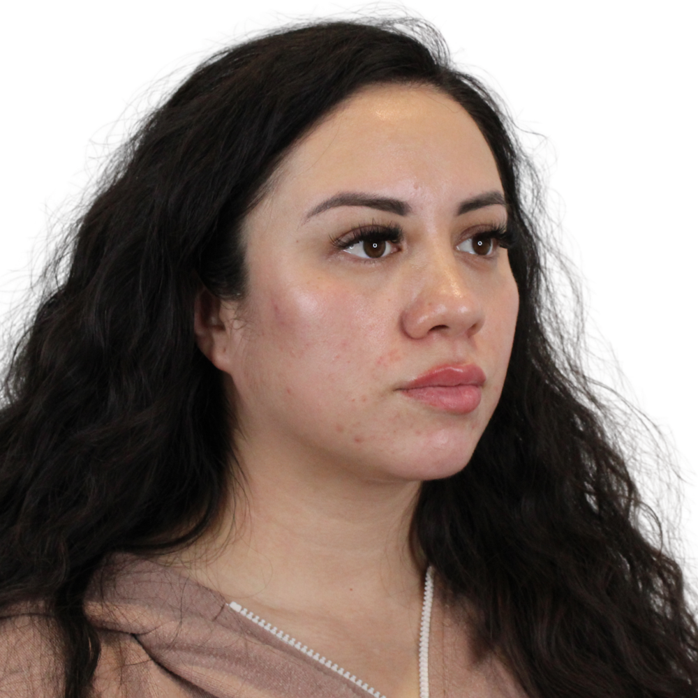 Cheek Filler  Before & After Gallery - Patient 939374 - Image 4