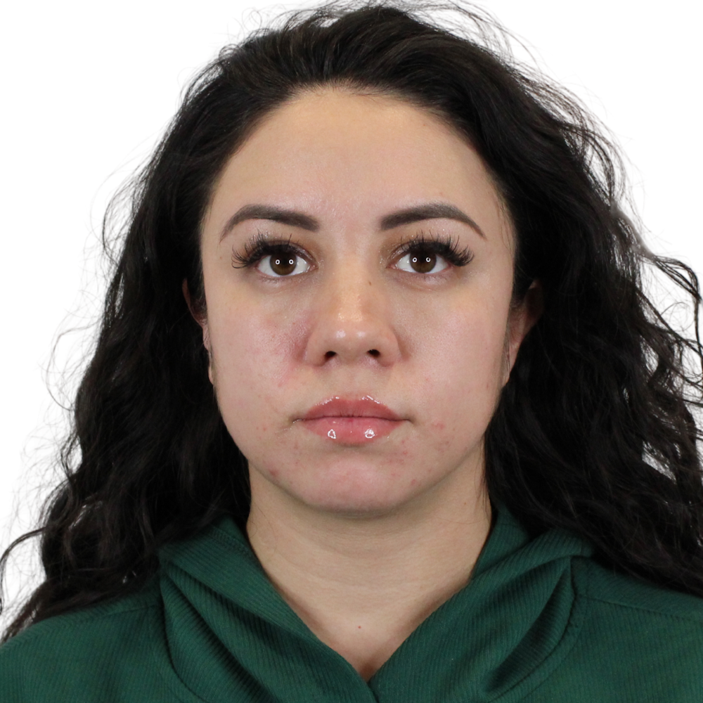 Cheek Filler  Before & After Gallery - Patient 939374 - Image 1