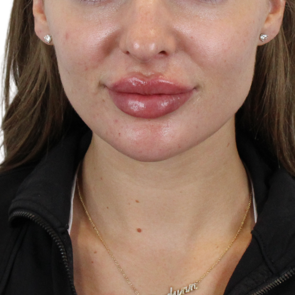 Lip Filler Before & After Gallery - Patient 244636 - Image 2