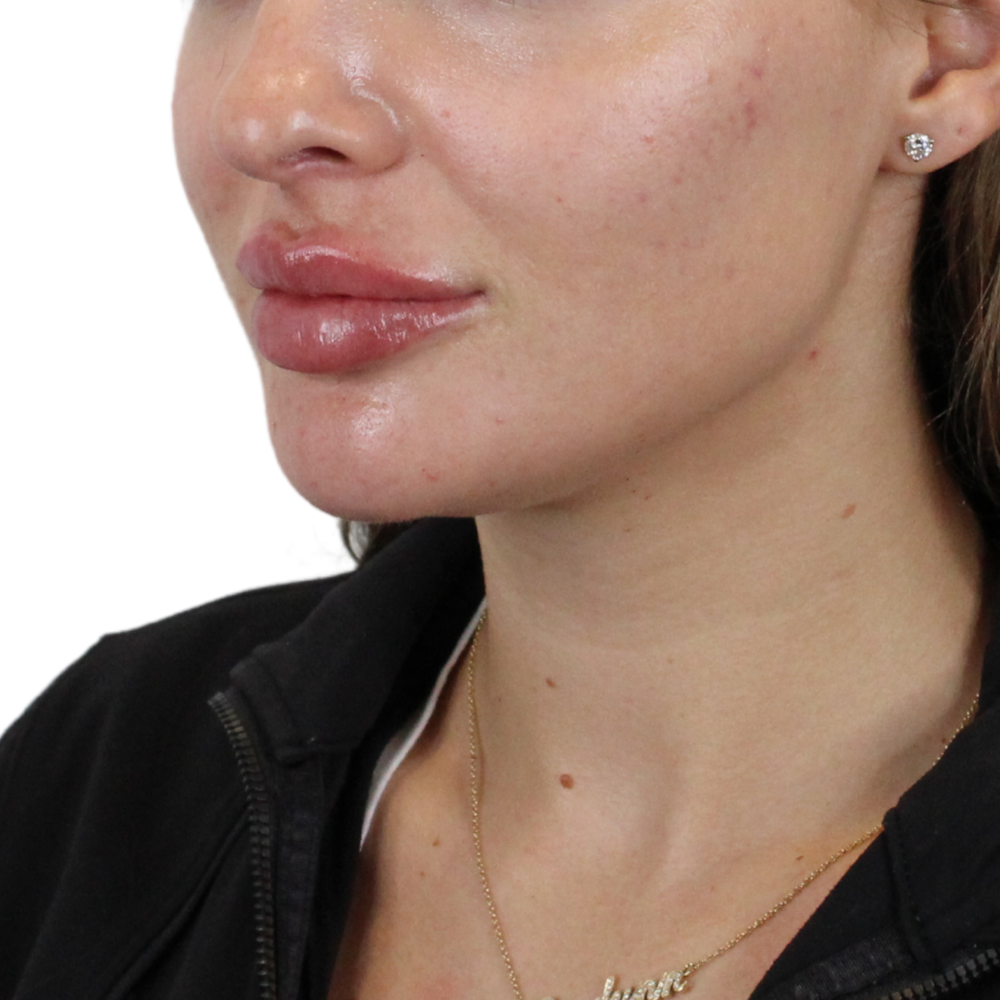 Lip Filler Before & After Gallery - Patient 244636 - Image 6
