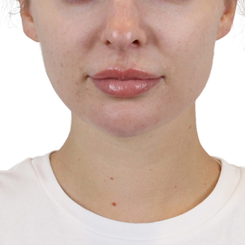 Lip Filler Before & After Gallery - Patient 244636 - Image 1