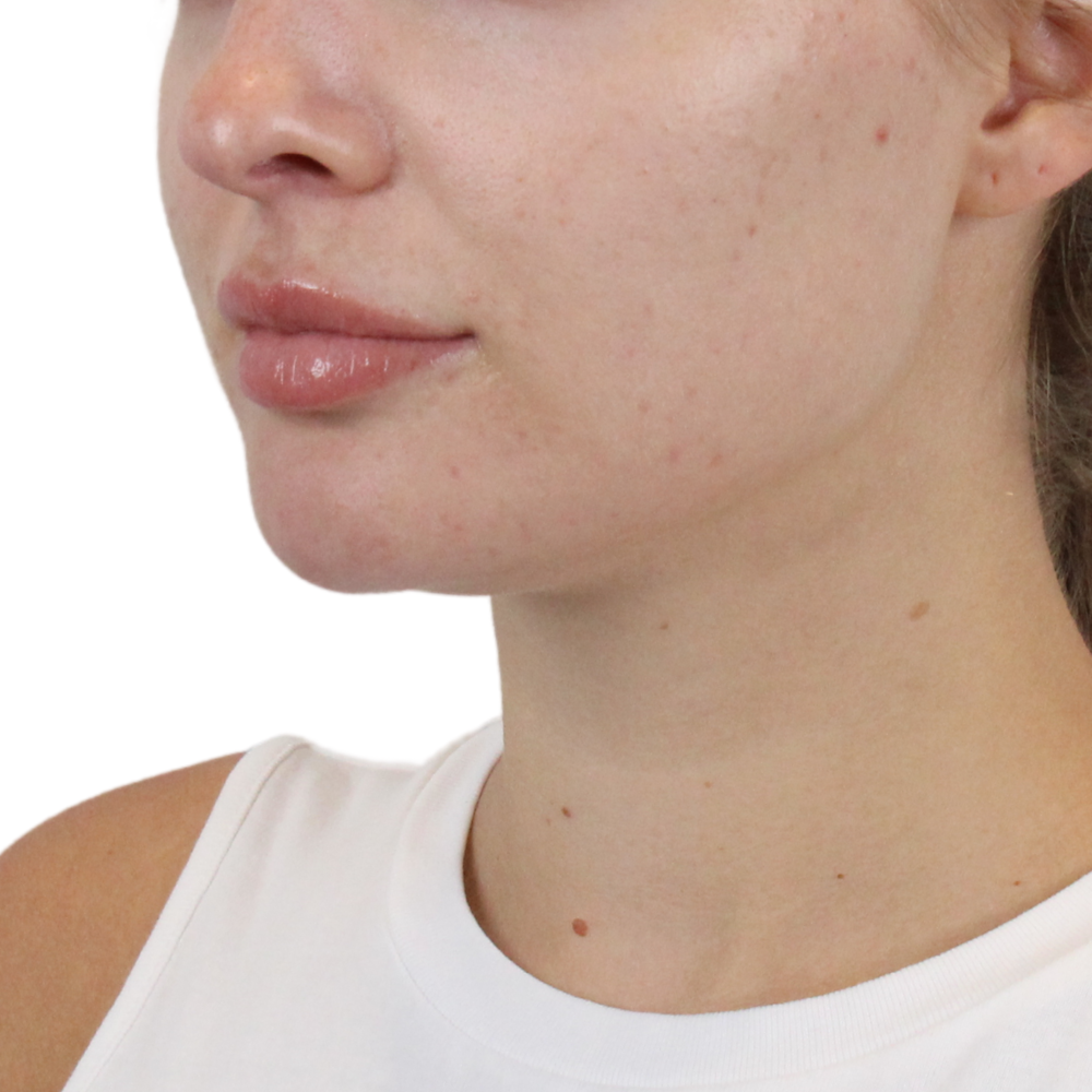 Lip Filler Before & After Gallery - Patient 244636 - Image 5