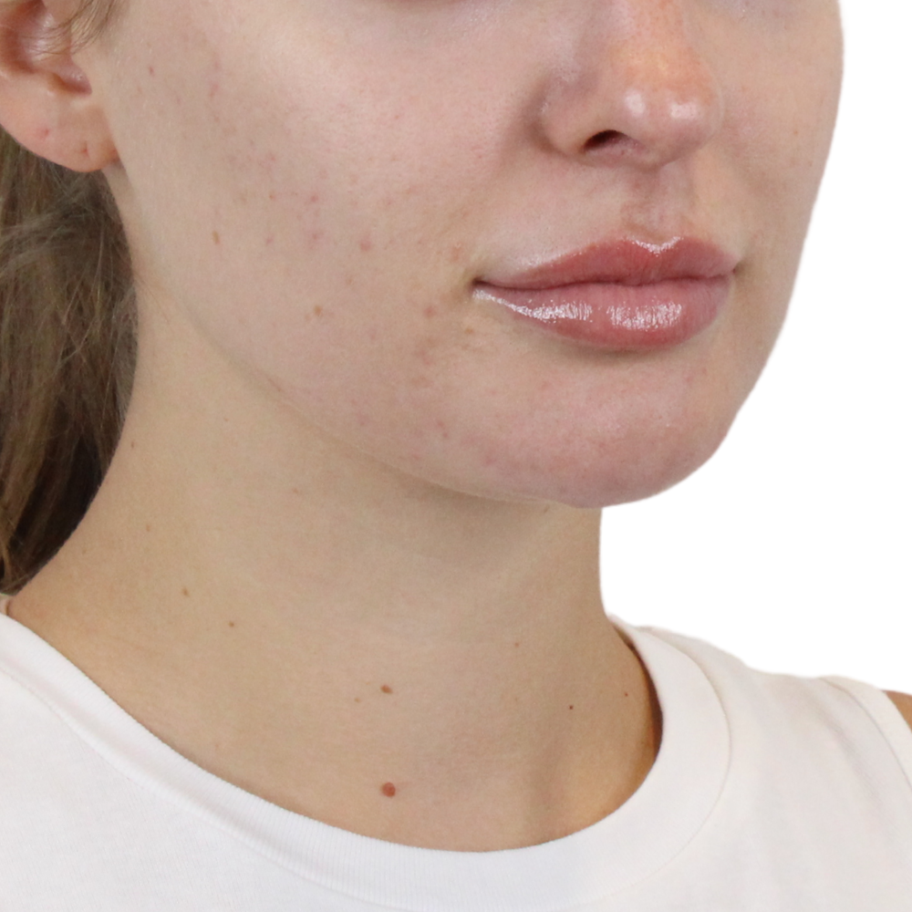 Lip Filler Before & After Gallery - Patient 244636 - Image 3