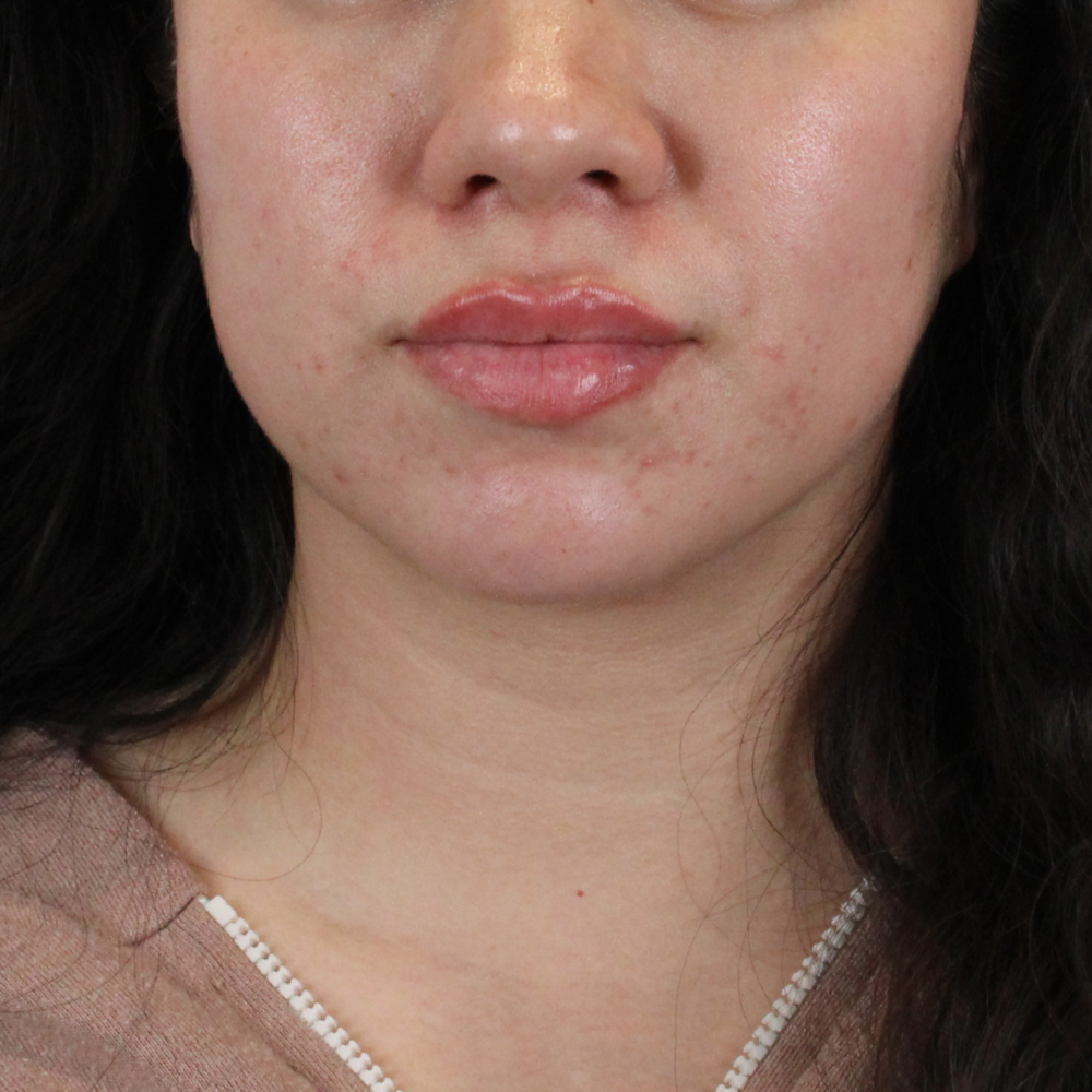 Lip Filler Before & After Gallery - Patient 258428 - Image 2