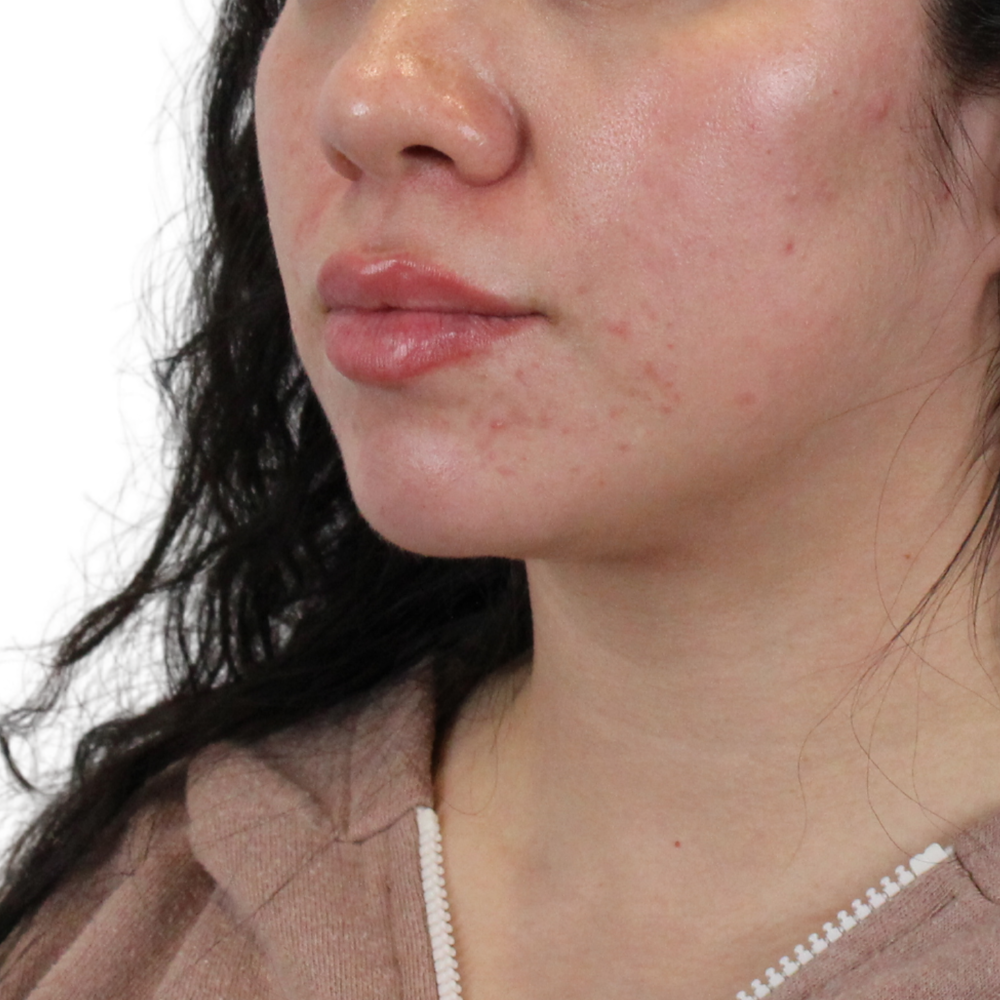 Lip Filler Before & After Gallery - Patient 258428 - Image 6