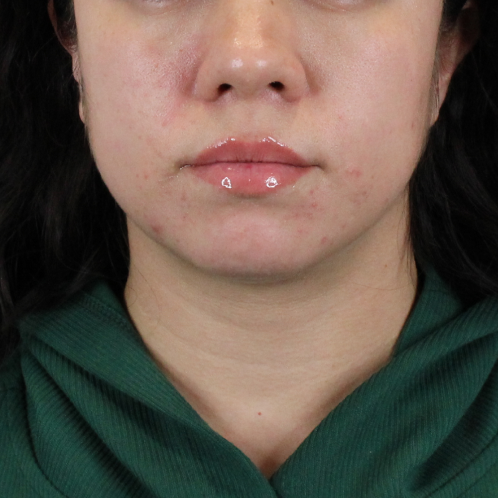 Lip Filler Before & After Gallery - Patient 258428 - Image 1