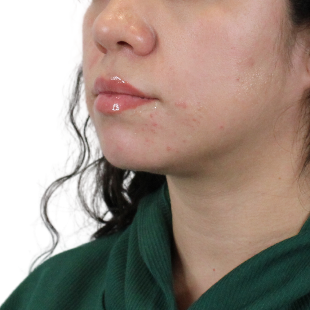 Lip Filler Before & After Gallery - Patient 258428 - Image 5