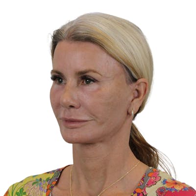 Deep Plane Facelift Before & After Gallery - Patient 227073 - Image 10