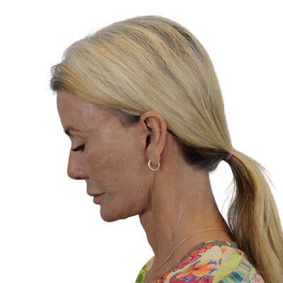 Deep Plane Facelift Before & After Gallery - Patient 227073 - Image 14