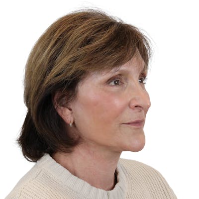 Deep Plane Facelift Before & After Gallery - Patient 919648 - Image 4