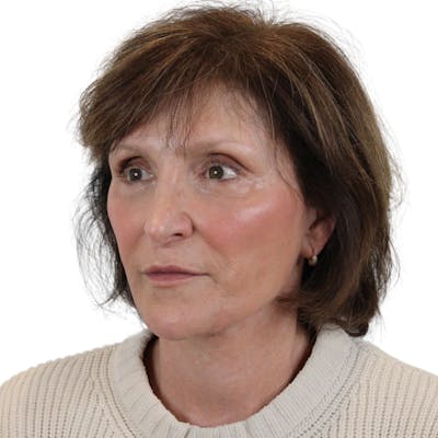 Deep Plane Facelift Before & After Gallery - Patient 919648 - Image 8