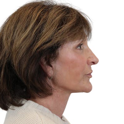 Deep Plane Facelift Before & After Gallery - Patient 919648 - Image 6