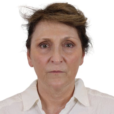 Deep Plane Facelift Before & After Gallery - Patient 919648 - Image 1