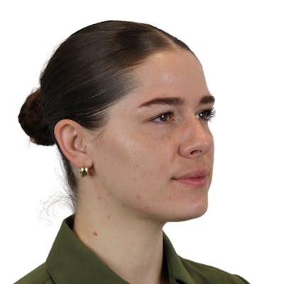 BOTOX  Before & After Gallery - Patient 400872 - Image 6