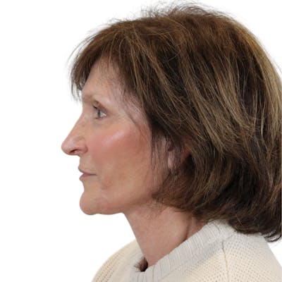 Cheek Filler  Before & After Gallery - Patient 378325 - Image 16