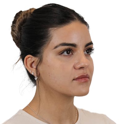 Chin Filler Before & After Gallery - Patient 220681 - Image 4