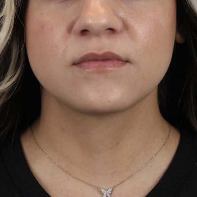 Lip Filler Before & After Gallery - Patient 106247 - Image 1