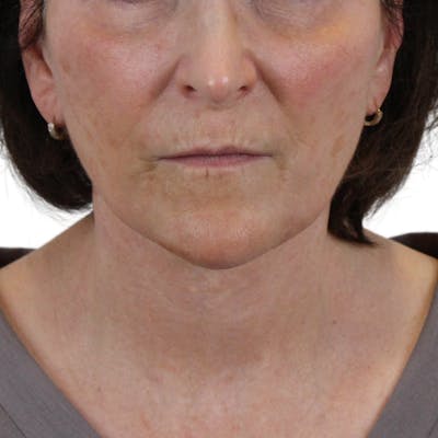 Lip Filler Before & After Gallery - Patient 273585 - Image 1