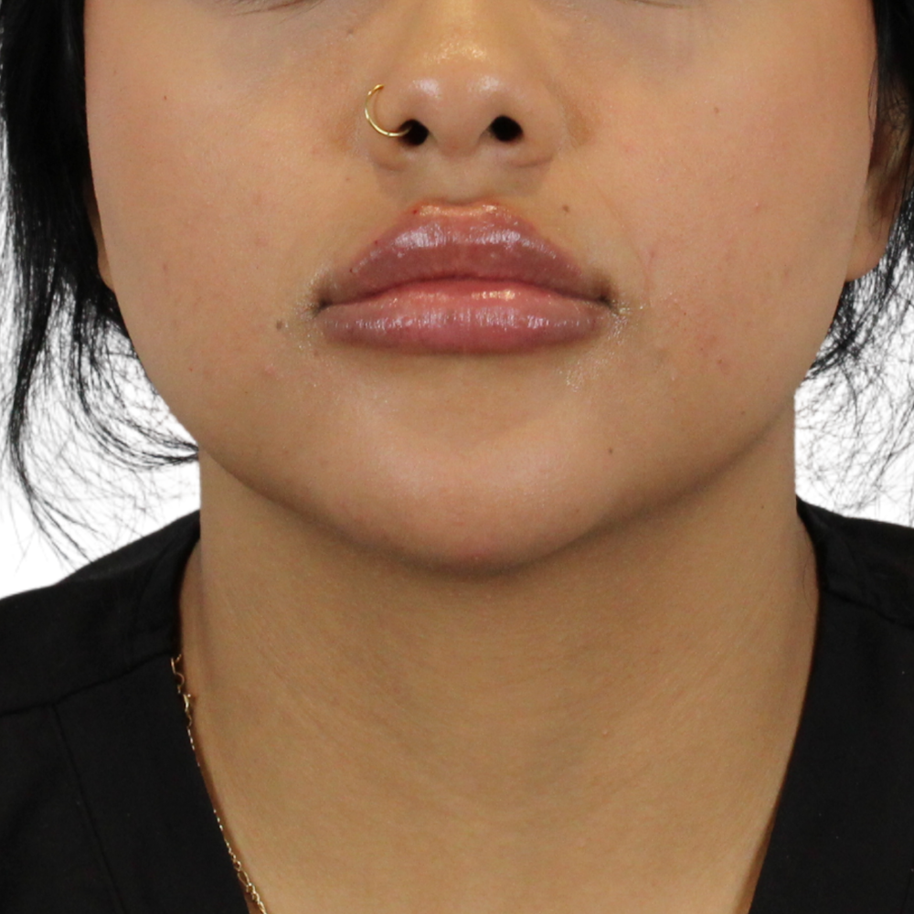 Lip Filler Before & After Gallery - Patient 372485 - Image 2