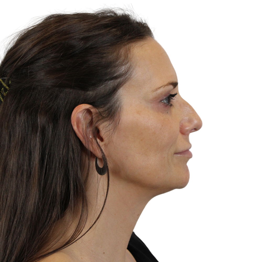 Sculptra Before & After Gallery - Patient 414698 - Image 5