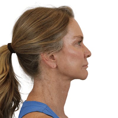 Deep Plane Facelift Before & After Gallery - Patient 429307 - Image 8