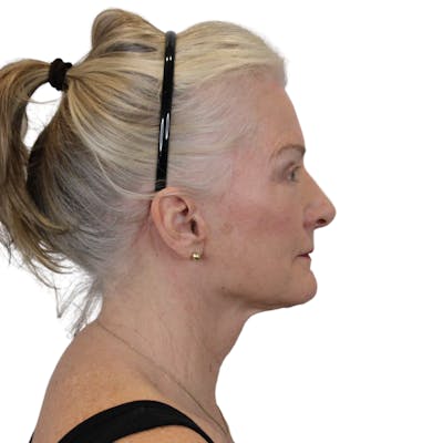 Deep Plane Facelift Before & After Gallery - Patient 663703 - Image 8