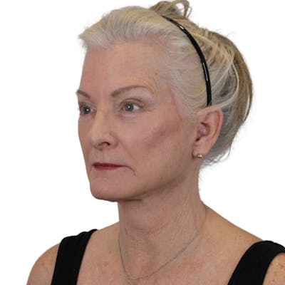 Deep Plane Facelift Before & After Gallery - Patient 663703 - Image 4
