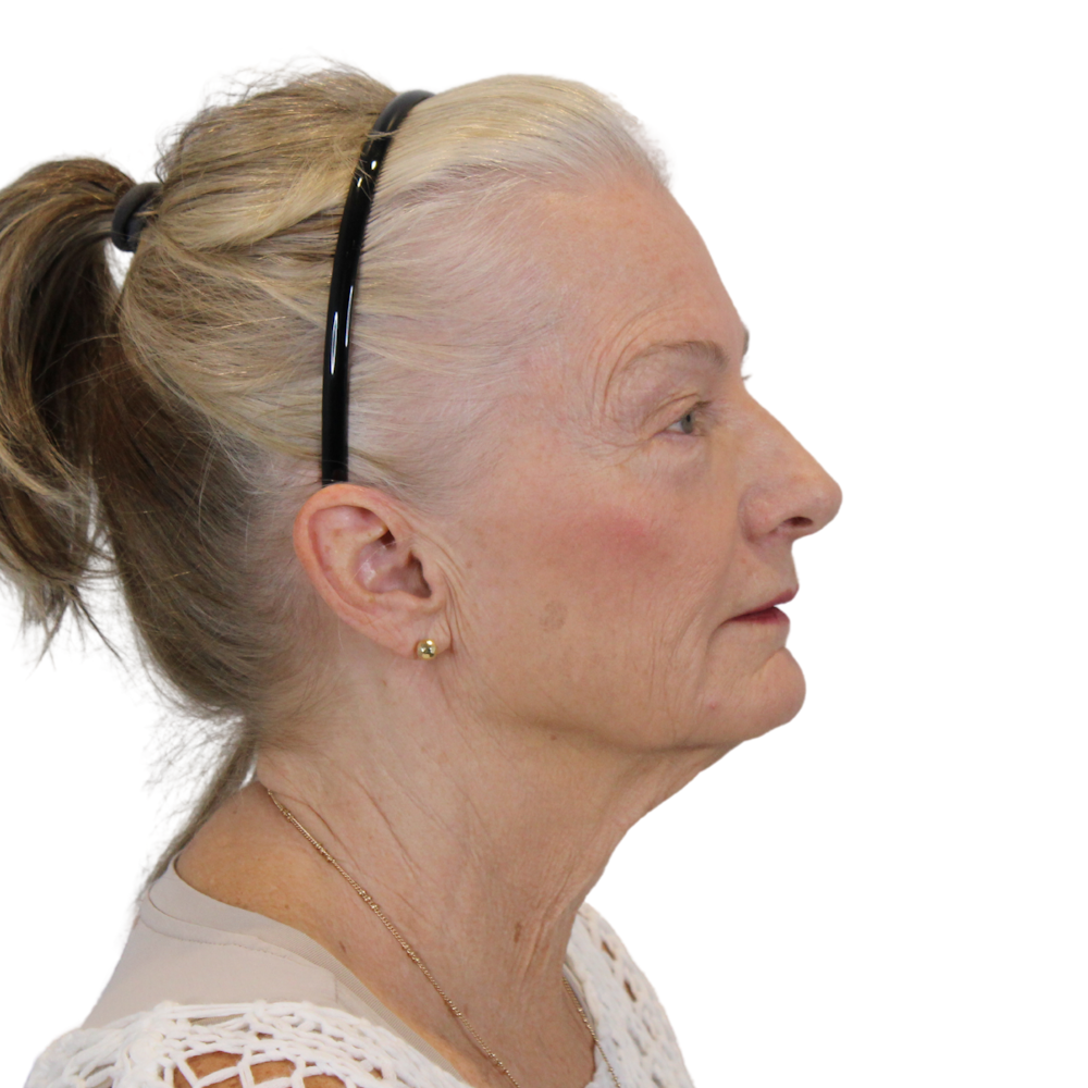 Deep Plane Facelift Before & After Gallery - Patient 663703 - Image 7