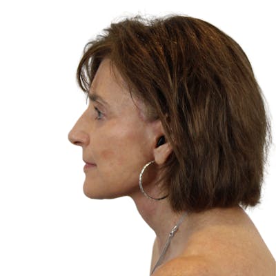 Deep Plane Facelift Before & After Gallery - Patient 189551 - Image 6