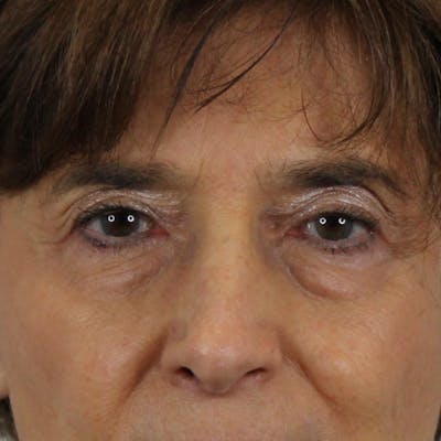 Blepharoplasty Before & After Gallery - Patient 278211 - Image 1