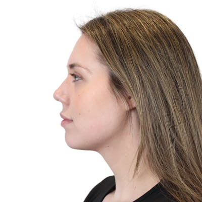 Cheek Filler  Before & After Gallery - Patient 247220 - Image 6