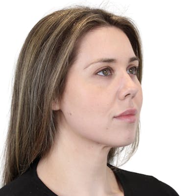 Cheek Filler  Before & After Gallery - Patient 247220 - Image 10