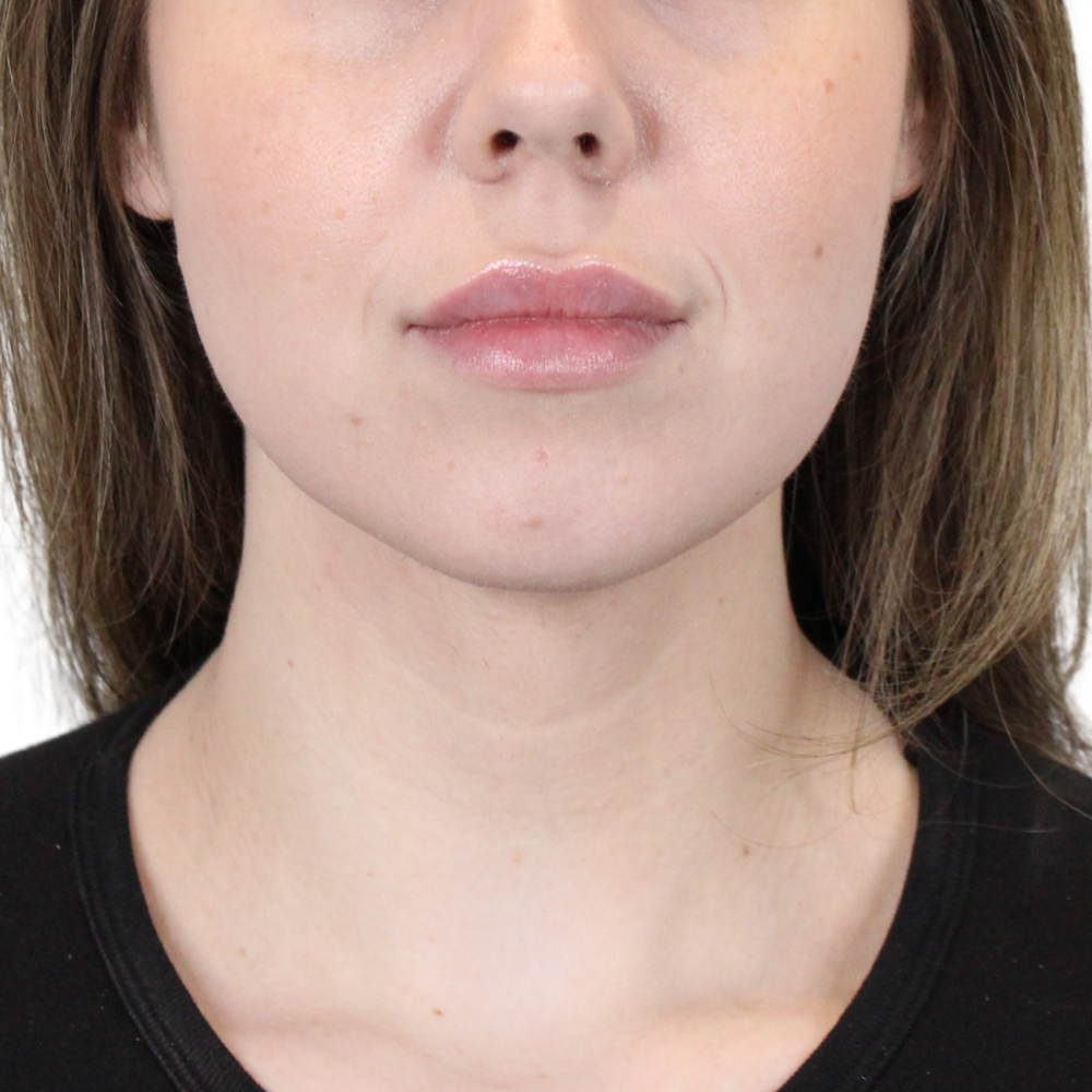 Lip Filler Before & After Gallery - Patient 197802 - Image 2