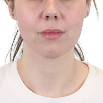 Lip Filler Before & After Gallery - Patient 197802 - Image 1