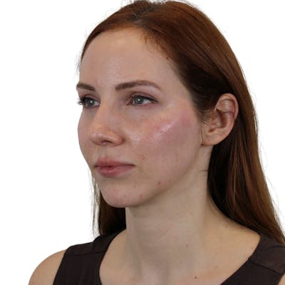 Cheek Filler  Before & After Gallery - Patient 120535 - Image 4