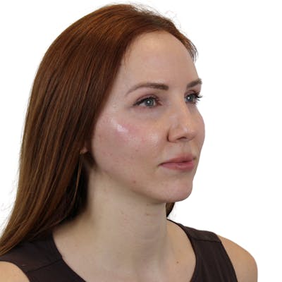 Cheek Filler  Before & After Gallery - Patient 120535 - Image 6