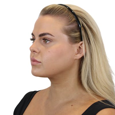 Cheek Filler  Before & After Gallery - Patient 191591 - Image 4