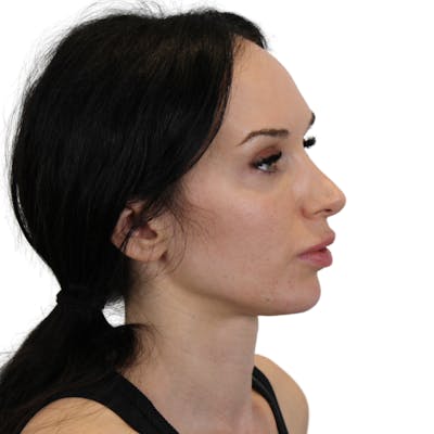 Chin Filler Before & After Gallery - Patient 261952 - Image 8