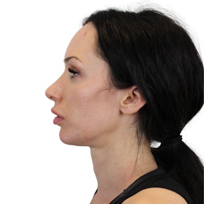 Chin Filler Before & After Gallery - Patient 261952 - Image 6