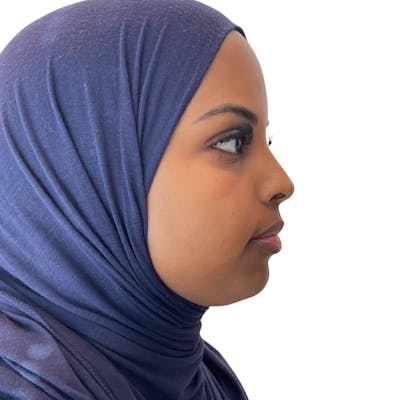 Chin Filler Before & After Gallery - Patient 344718 - Image 4