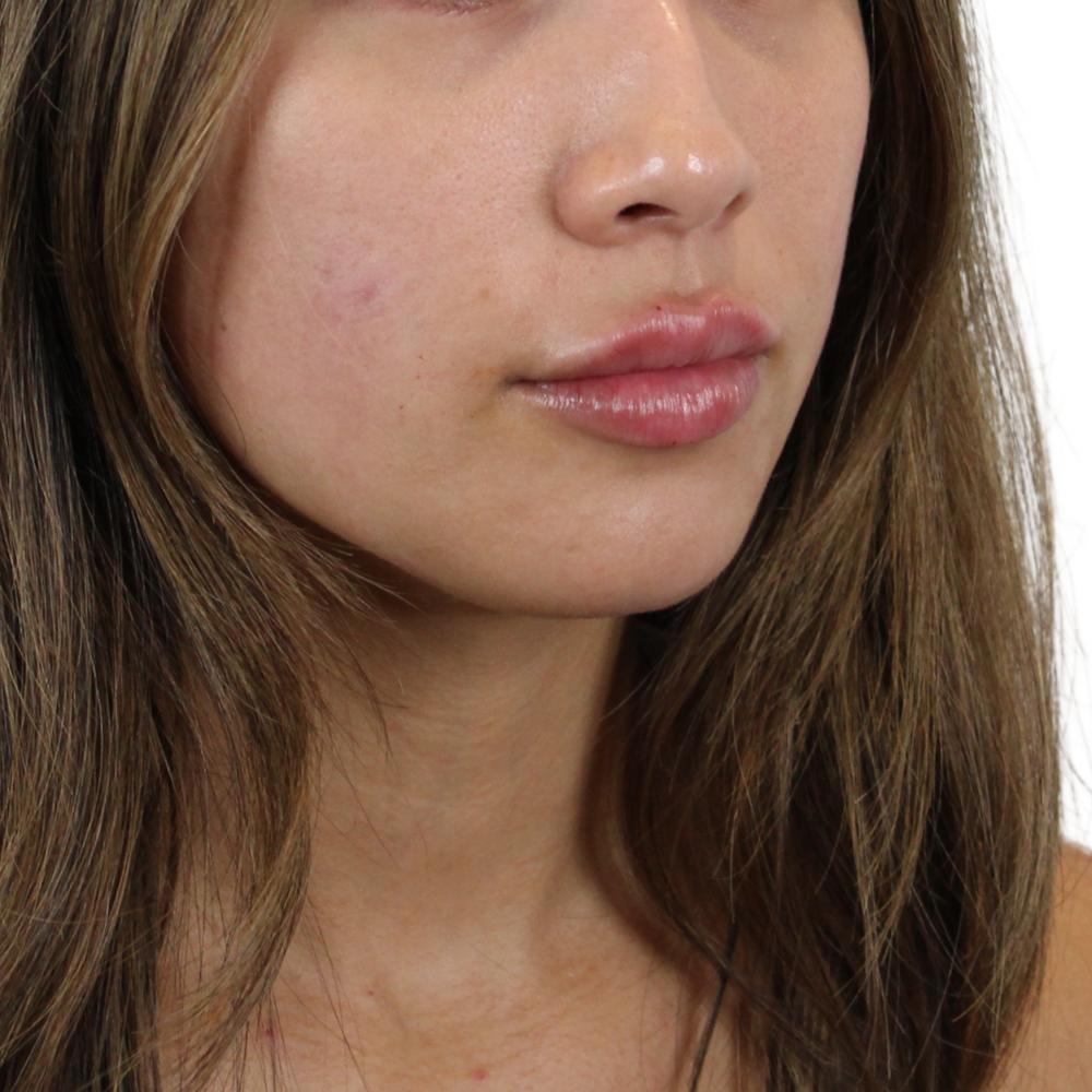 Lip Filler Before & After Gallery - Patient 124986 - Image 6