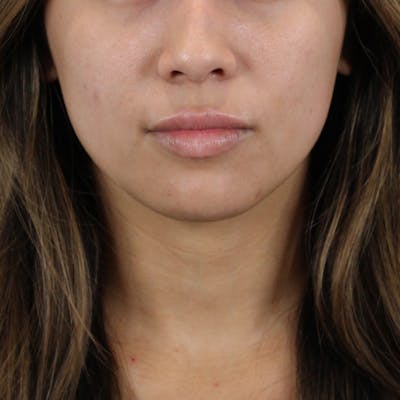 Lip Filler Before & After Gallery - Patient 124986 - Image 1
