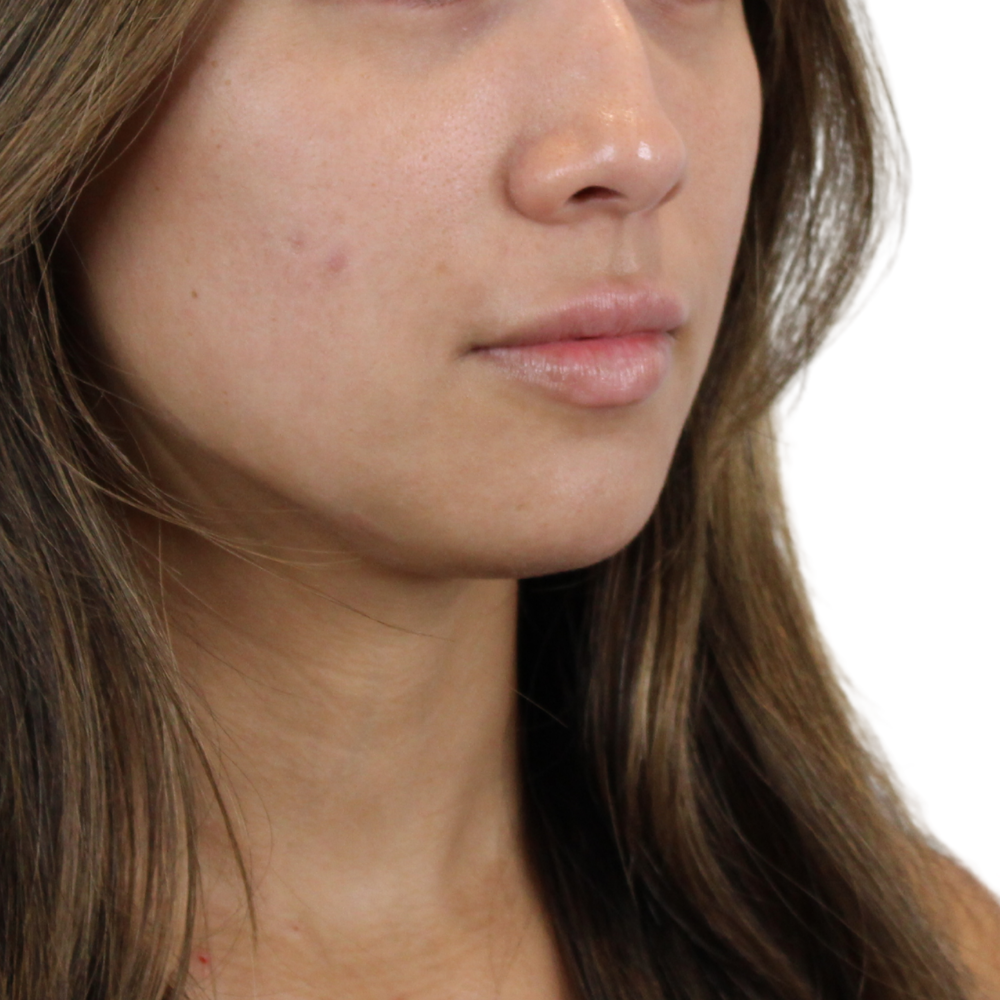 Lip Filler Before & After Gallery - Patient 124986 - Image 5